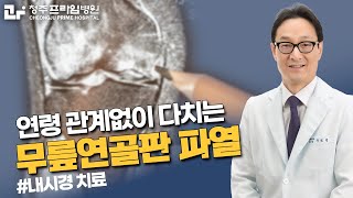 연령 관계없이 다치는 무릎 연골판 파열 [upl. by Ginny791]