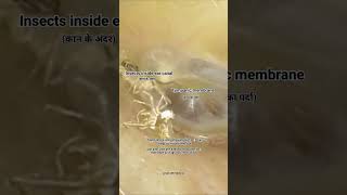 Insects inside ear canalNEET motivation NEET 2024 shortsmbbsneetaiimssscipsias kota [upl. by Hselin]