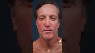 TRACELESS FACE amp NECK LIFT Before and After  Proof You NEED It [upl. by Llevol13]