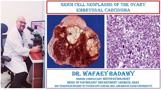 GERM CELL NEOPLASMS OF THE OVARY EMBRYONAL CARCINOMA BY DR WAFAEY BADAWY [upl. by Eellah]