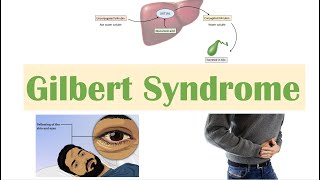 Gilbert Syndrome  Causes Genetics Pathogenesis Signs amp Symptoms Diagnosis Treatment [upl. by Kaylee]