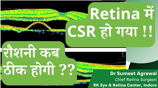 CSR RETINA में SWELLING हो गया  अब नज़र कब ठीक होगी [upl. by Sparrow497]