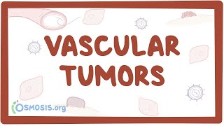 Vascular tumors kaposi hemangioma angiosarcoma  causes amp symptoms [upl. by Ashti]