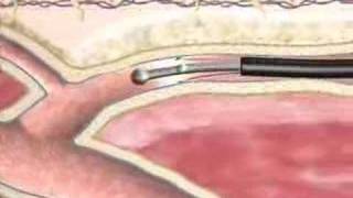 Varicose Veins Closure Procedure at BIDMC [upl. by Aronoh]