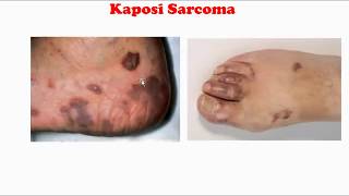 Kaposi sarcoma [upl. by Reagen]