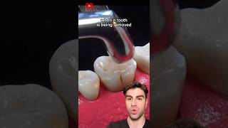 Tooth Extraction The ACTUAL Process Explained [upl. by Zeculon]