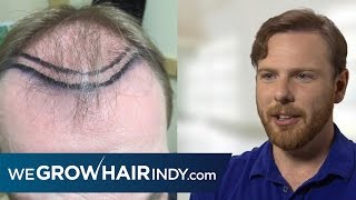 MultiUnit Hair Grafting™ Hair Transplant  PAI Medical Group of Indiana  Sean [upl. by Schlosser582]