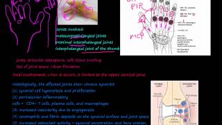 93P What is Rheumatoid Arthritis RA morphology prevalence pannus Rheumatoid nodules [upl. by Ellehsem]