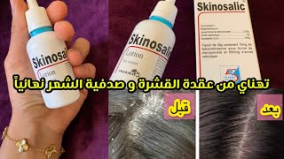 تجربتي مع SKINOSALIC تهنيت من قشرةالشعر والصدفية من اول استعمال طريقتي في استعمالو لنتائج مبهرة [upl. by Anyak208]