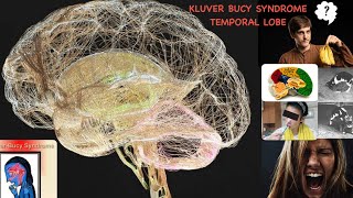 Temporal lobe and kluver bucy syndrome  HAND WRITTEN NOTES [upl. by Vanhook]