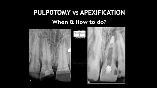 PULPOTOMY vs APEXIFICATION  When amp How [upl. by Eiramaliehs]