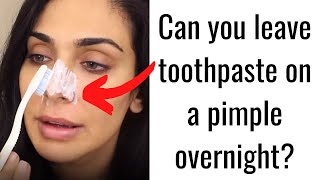 Can you leave toothpaste on a pimple overnight [upl. by Akselav772]