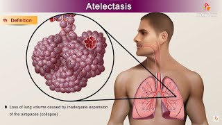 Atelectasis  Etiology Clinical Features Pathology pathophysiology Diagnosis and Treatment [upl. by Akimed948]