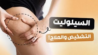 السيلوليت ، أساليب التشخيص والخيارات العلاجية الحديثة [upl. by Annaynek153]