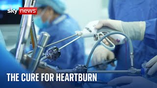 Heartburn Revolutionary surgical procedure cures condition with a device [upl. by Rita]