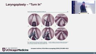 Management of Anterior Glottic Web Dr Brandon Jackson Baird [upl. by Pallaton]