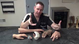 Partial Hand Prosthesis siliconeprosthetics artificial finger youtube [upl. by Ettennyl]