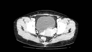 Right Paraduodenal Hernia [upl. by Aisha]