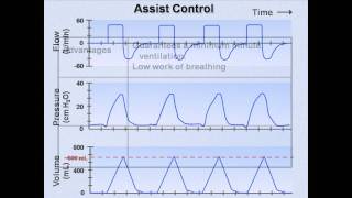 Ventilator Modes Mechanical Ventilation  Lecture 7 [upl. by Yedsnil182]