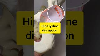 Hip Joint Cartilage Disruption Model [upl. by Attiuqaj17]