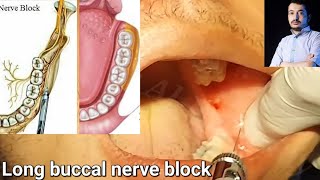 Local Anesthesia Long Buccal Nerve Block Technique Mandibular Anesthesia techniques dentistry [upl. by Declan584]