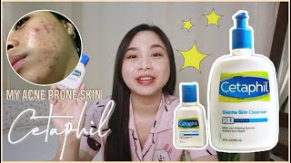 CETAPHIL Gentle Skin Cleanser Review  Maganda ba sa acne prone skin 🤔 [upl. by Siravart]