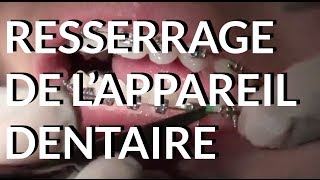 Resserrage de lappareil dentaire  Appareildentaireinfo [upl. by Lleral]