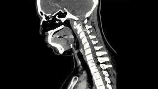 Calcifications of the longus colli [upl. by Keppel]