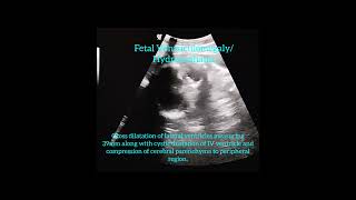 Dandy Walker Spectrum Disorder  Fetal Hydrocephalus  Fetal Ventriculomegaly [upl. by Alliber527]