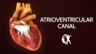 Atrioventricular Septal Defect  AV Canal [upl. by Lepley936]