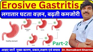 Understanding Erosive Gastritis Causes Symptoms and Management Strategiesdrramakantsharma7 [upl. by Tessie]