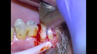 58 Surgical Molar Extraction [upl. by Zeugirdor]