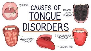 Understanding Tongue Disorders Causes and Management [upl. by Rogerio540]