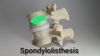 Spondylolisthesis Lumbar Model by Dynamic Disc Designs Grade 1 Anterolisthesis [upl. by Christis909]