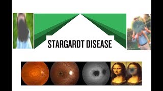 Stargardts Disease Hindi [upl. by Karil]