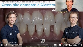 Ortodonzia con allineatori trasparenti Terza Classe Dentale prima dopo mascherine spazi tra i denti [upl. by Neeroc]