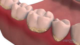 Decay formation  Lapointe dental centres [upl. by Rawley]