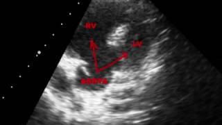 TETRALOGY OF FALLOT TOF  ECHOCARDIOGRAPHY SERIES BY DR ANKUR K CHAUDHARI [upl. by Nwahsar]