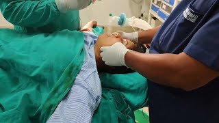 Extubation after surgery [upl. by Mavra]