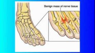 Mortons Neuroma [upl. by Sivet661]