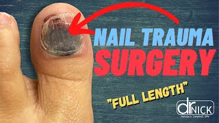 SMASHED TOENAIL NEEDS REMOVED SURGICAL VIDEO [upl. by Anak]