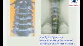 Traumatisme du rachis cervical symptôme diagnostic les Vertèbres cervicales bloquées [upl. by Duwad]