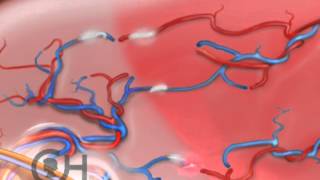 Treatment Options TwinTwin Transfusion Syndrome TTTS 5 of 9 [upl. by Esilram]