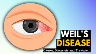 Weils Disease Causes Symptoms And Treatment [upl. by Lasley182]