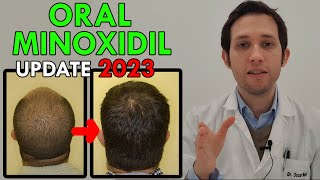 AVANCES en tratamiento CALVICIE no hormonal  MINOXIDIL ORAL 2023 [upl. by Yatnuahs]