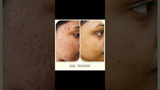 Best acne results by Dr Manisha Chauhan shortsacnetreatmentacneacnescarsacneproneskinacnecream [upl. by Ayitahs]