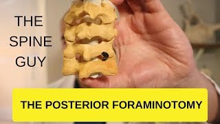 CERVICAL STENOSIS RADICULOPATHY  PART 4  THE POSTERIOR FORAMINOTOMY [upl. by Quartas]