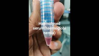 Haemoglobinemia indicative of haemolysis [upl. by Carbrey]