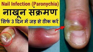 Nail Infection Paronychia  Cause amp Treatment  नाखून संक्रमण का इलाज कैसे करें [upl. by Hamo]