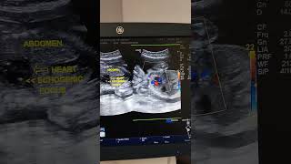 Fetal Echogenic Intracardiac Focus Ultrasound [upl. by Nosittam309]